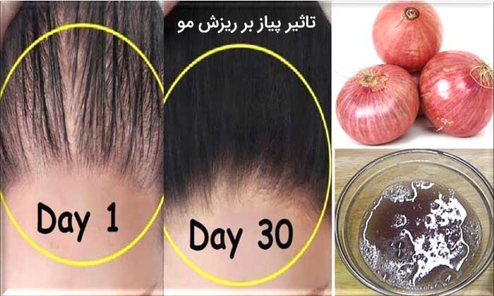 تاثیر آب پیاز در درمان ریزش مو